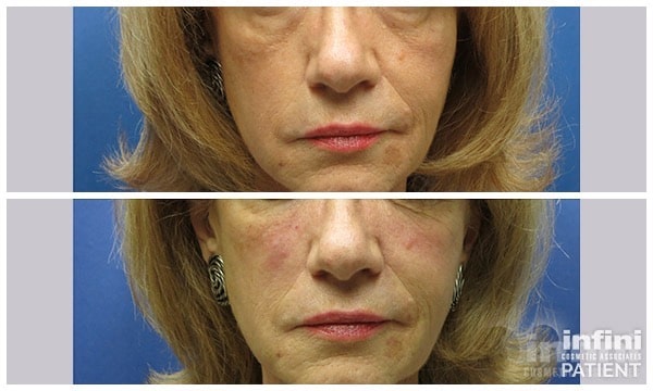 Voluma cheek volume result — patient 1