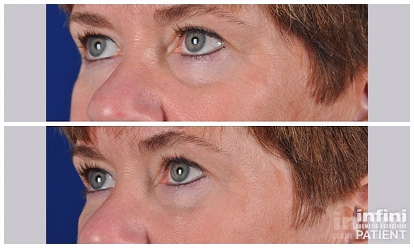 Voluma cheek volume result — patient 2