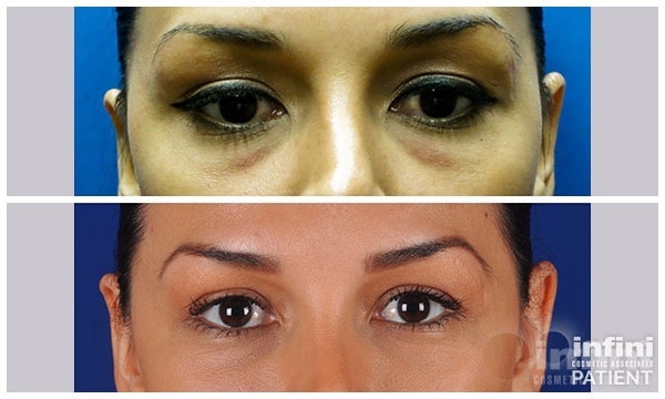 Voluma cheek volume result — patient 3