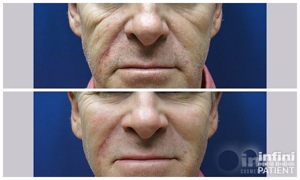 Voluma cheek volume result — patient 4