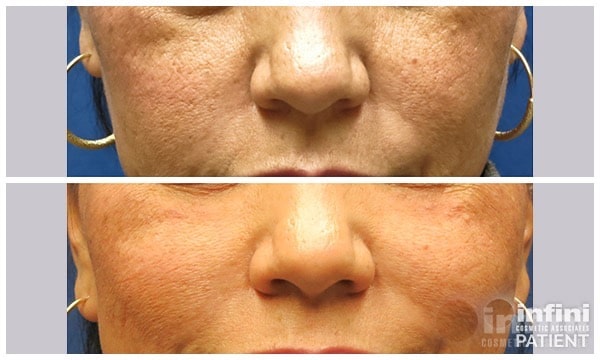 Voluma cheek volume result — patient 5