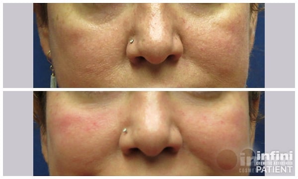 Voluma cheek volume result — patient 6