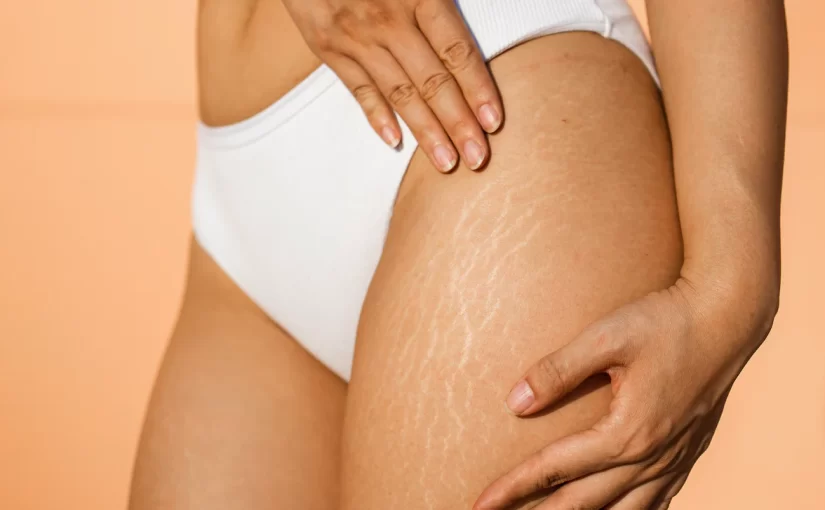 Stretch marks sales