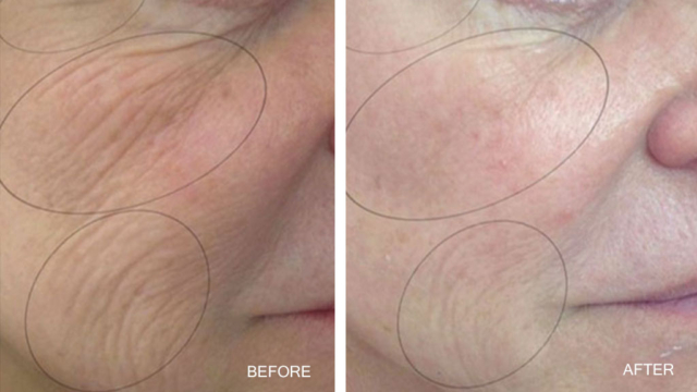 CO2Lift Pro Carboxy Gel Treatment