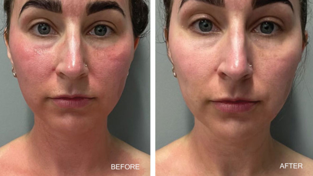 CO2Lift Pro Carboxy Gel Treatment