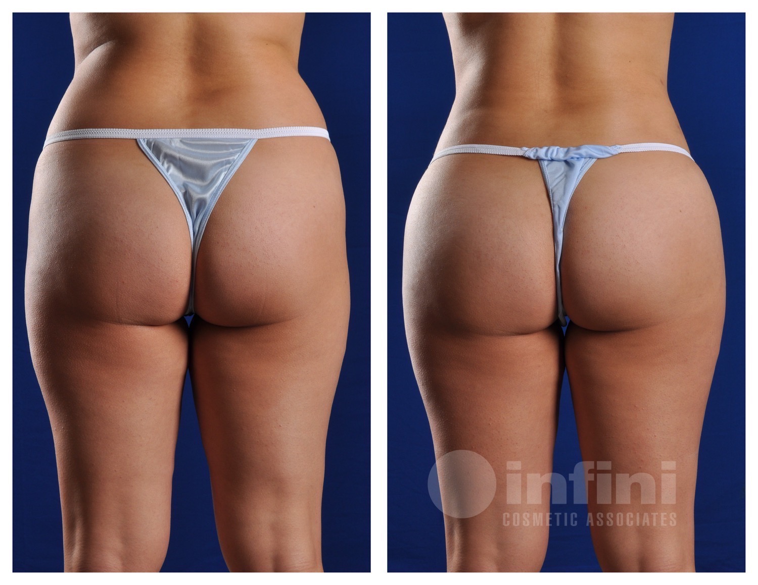 BBL before and after results - Patient 2