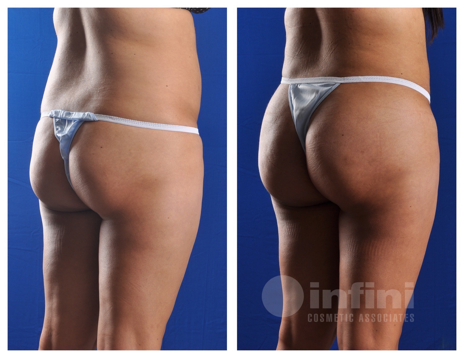 BBL  before and after results - Patient 3