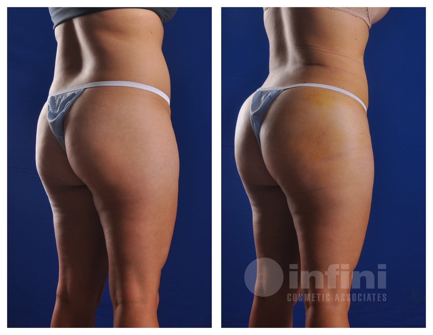 BBL before and after results - Patient 1