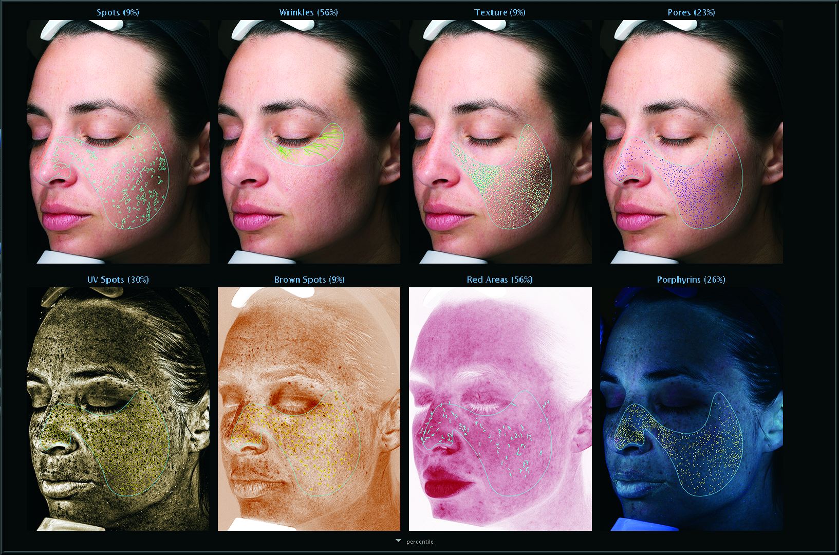 Skin Analysis Results Overview with VISIA System