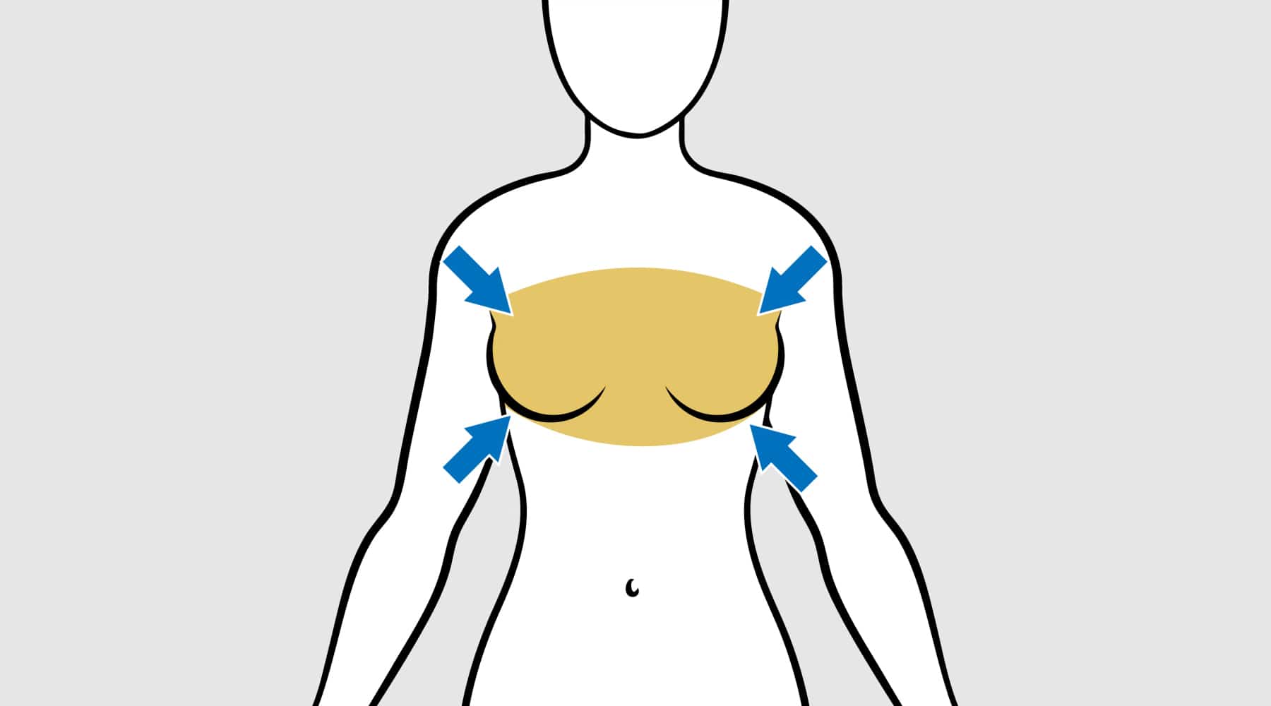 Scarless Breast Reduction