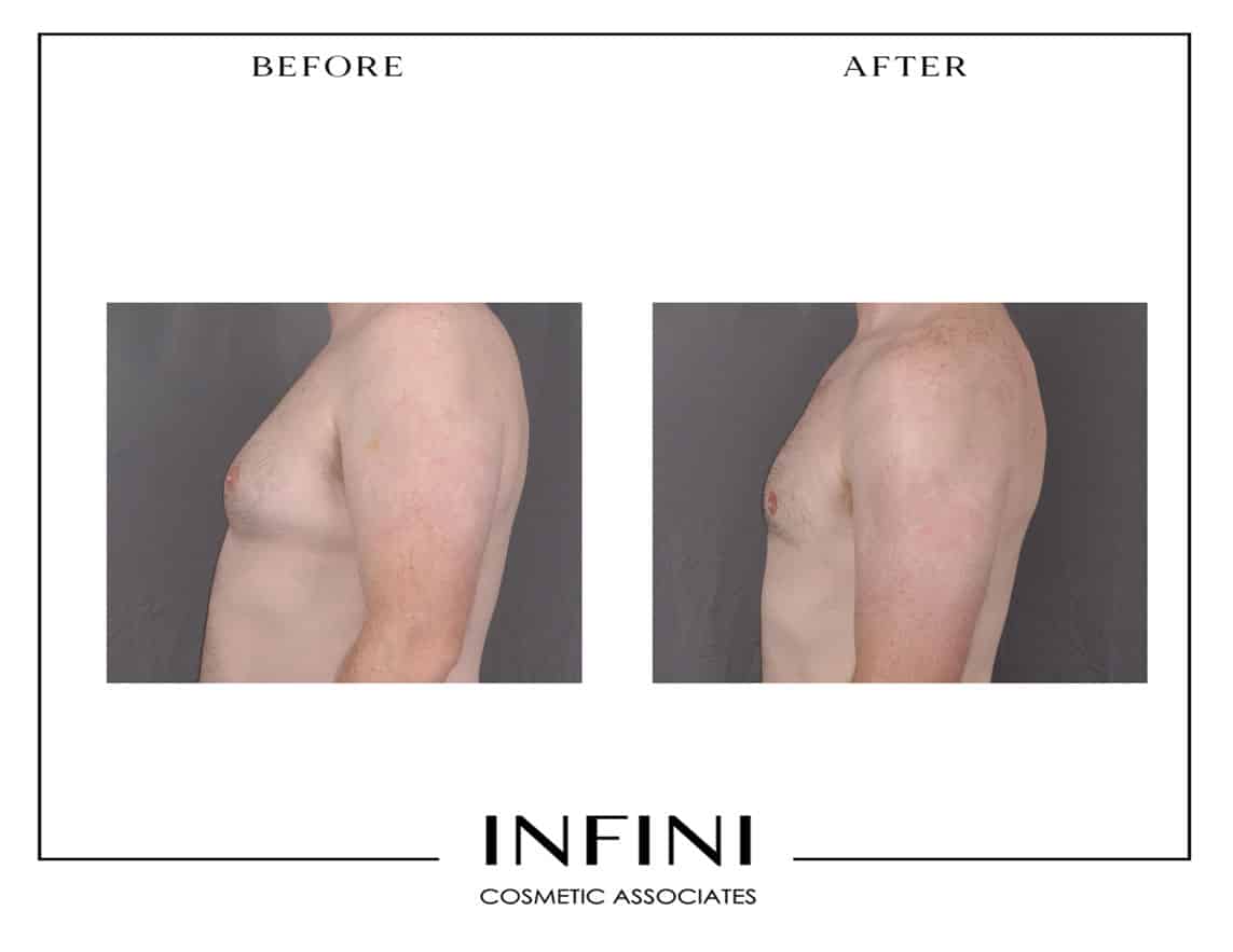 Gynecomastia  before and after results - Patient 3