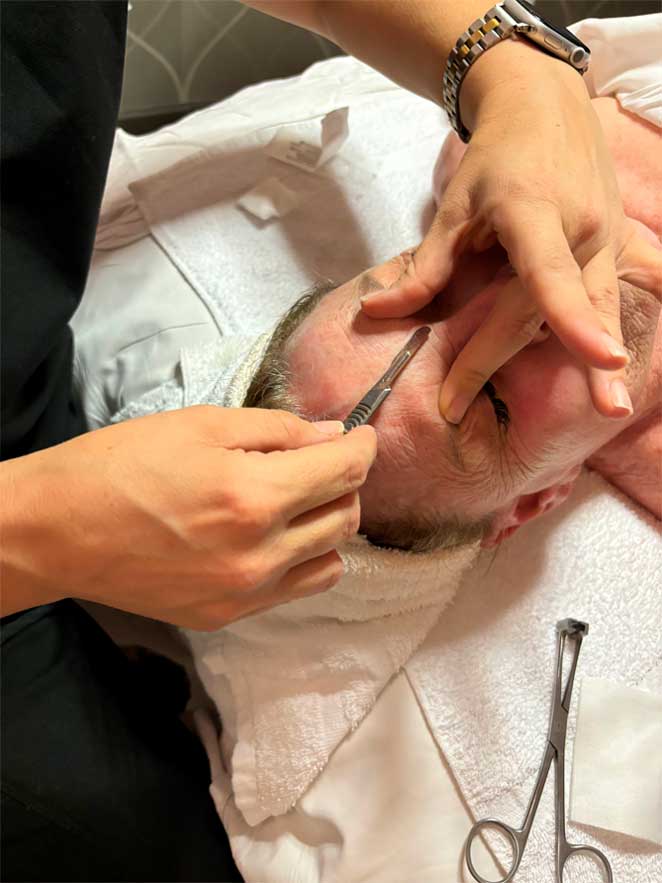 Sesión de tratamiento de dermaplaning