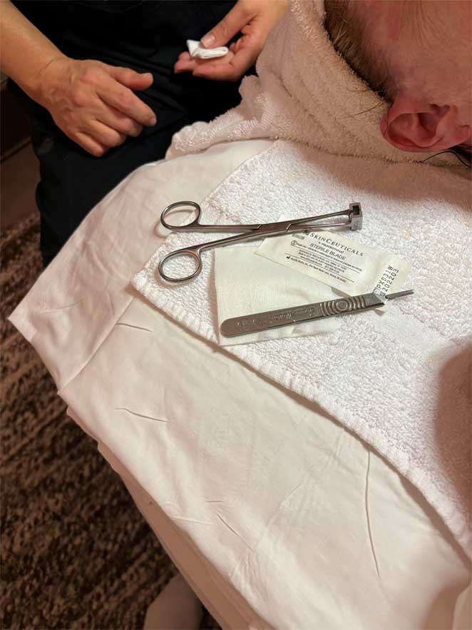 Tratamiento de dermaplaning eliminando vello facial