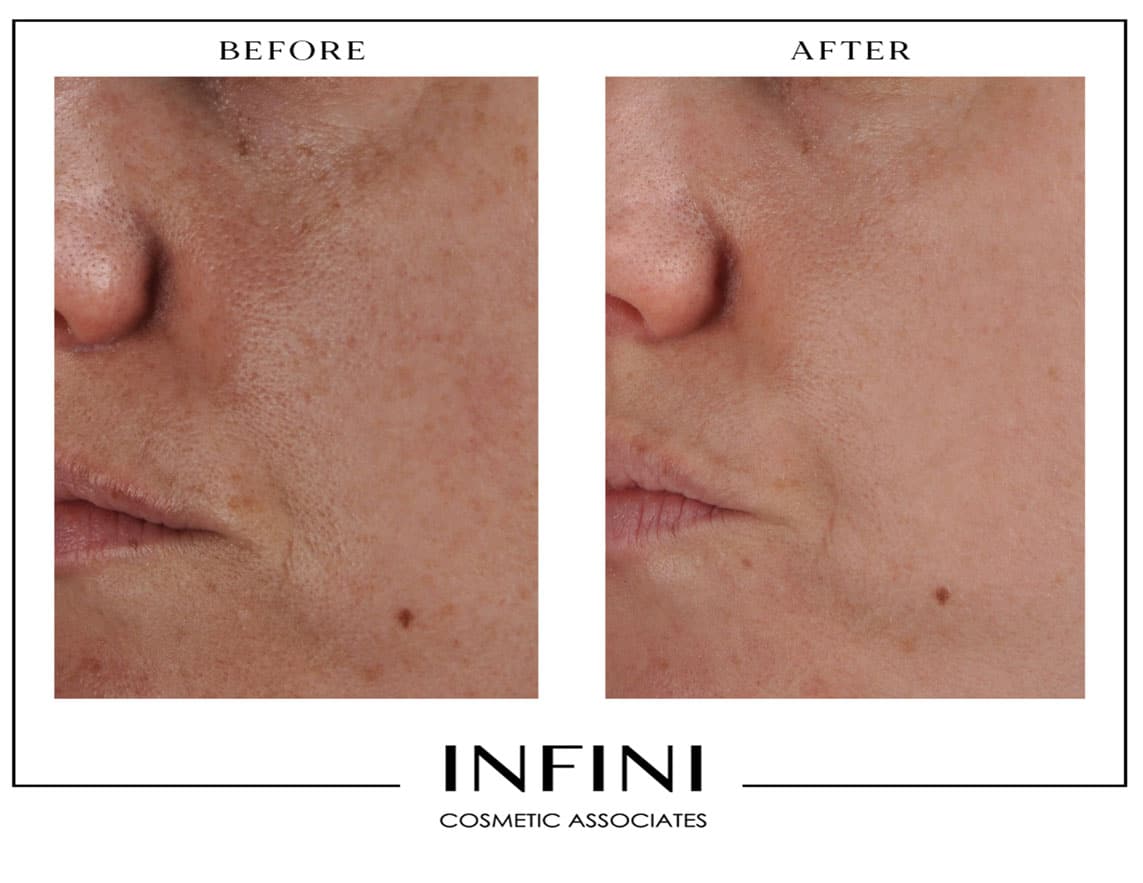 Before and after Clear + Brilliant treatment results - Patient 2