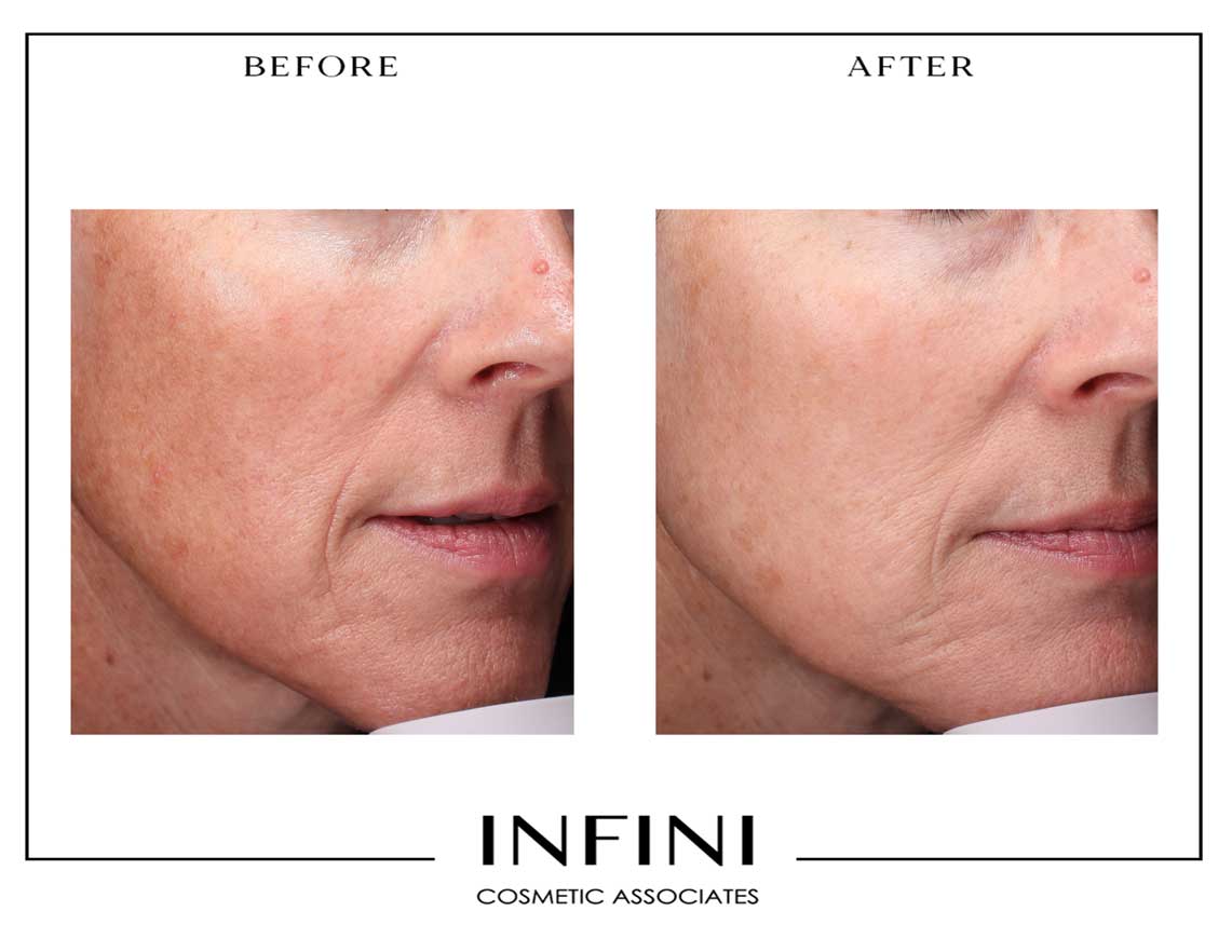 Before and after Clear + Brilliant treatment results - Patient 1