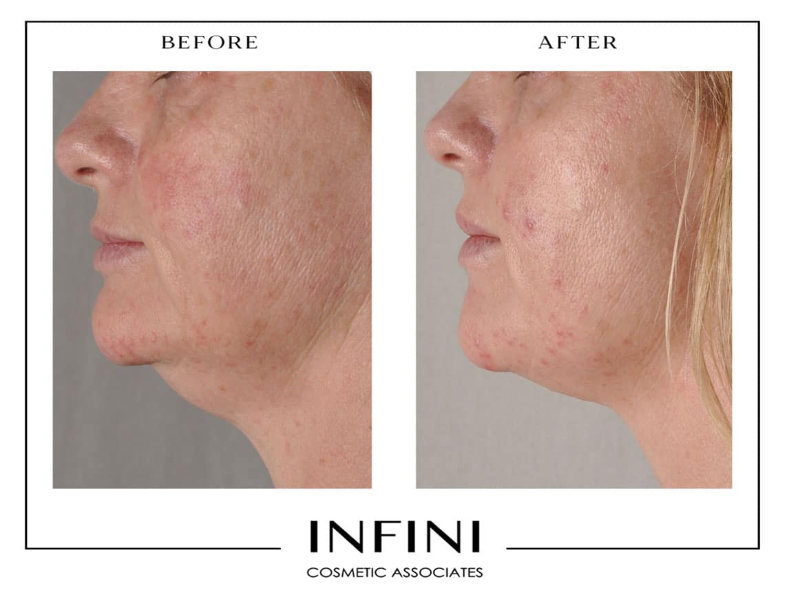 Photofacial before and after results - Patient 1