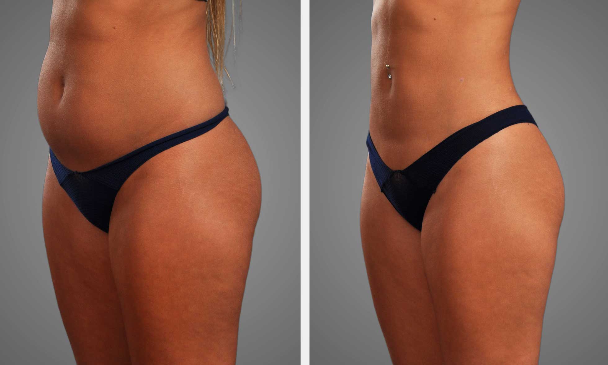 Gentle Sculpt™ Liposuction Procedure at Infini Cosmetic in Scottsdale Arizona