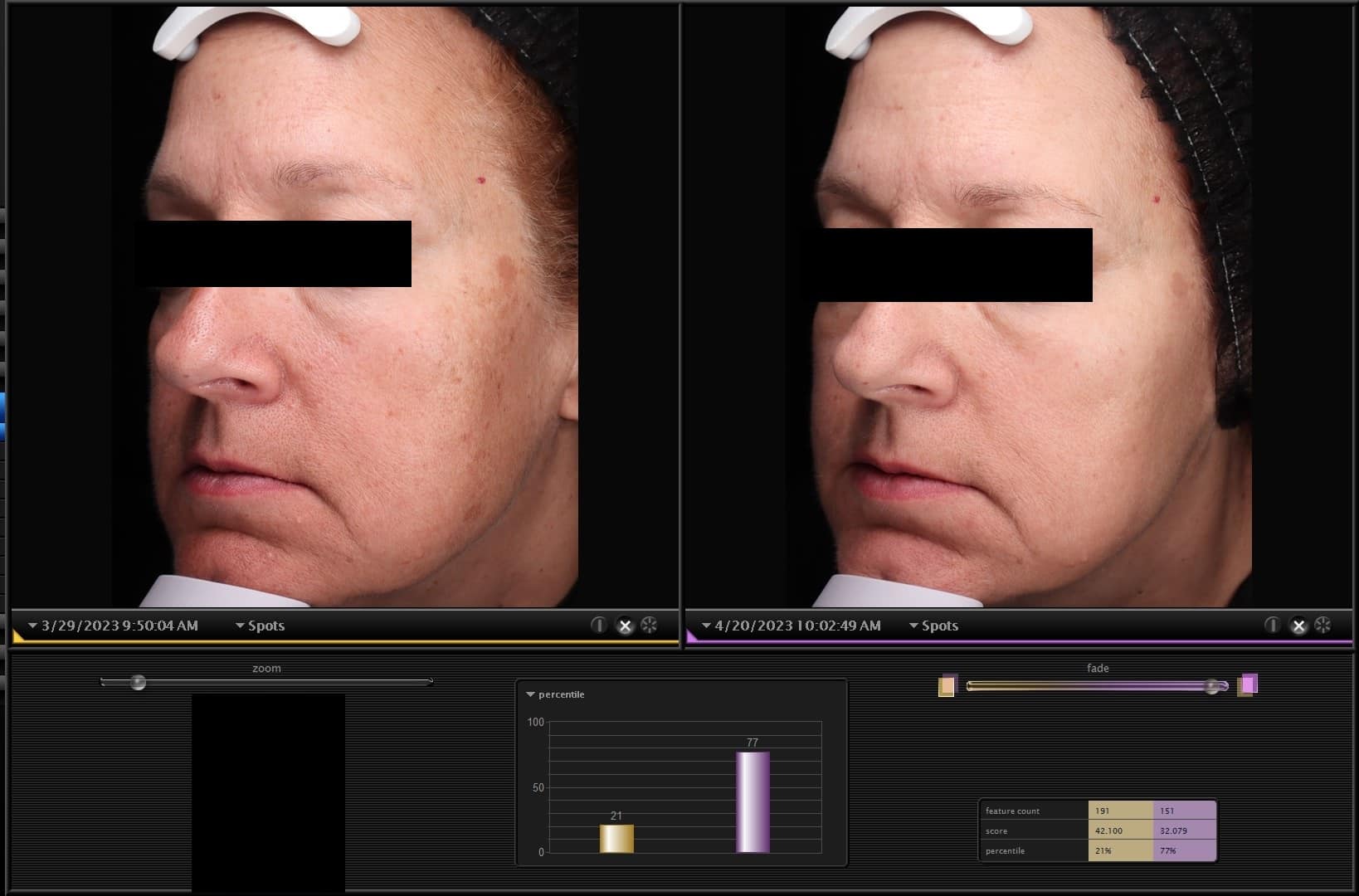 Skin Analysis Results Comparison with VISIA System