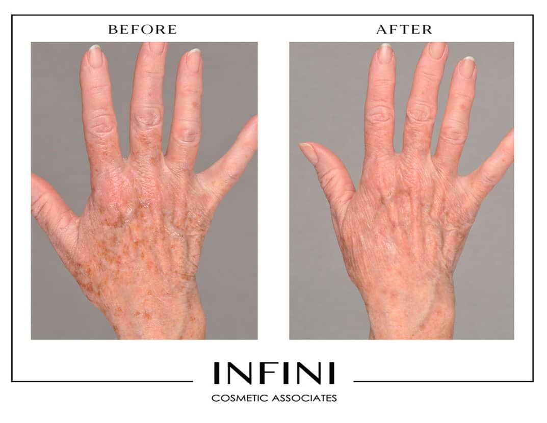 Photofacial before and after results - Patient 4