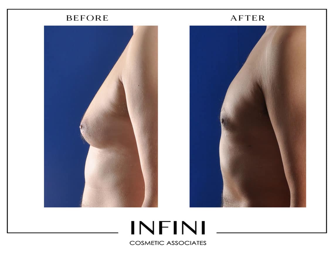 Gynecomastia and after results - Patient 1