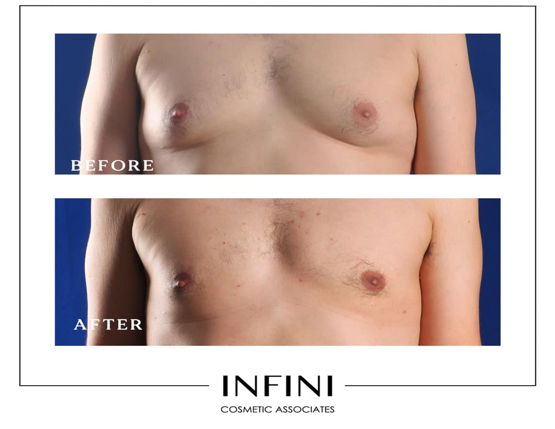 Gynecomastia before and after results - Patient 2