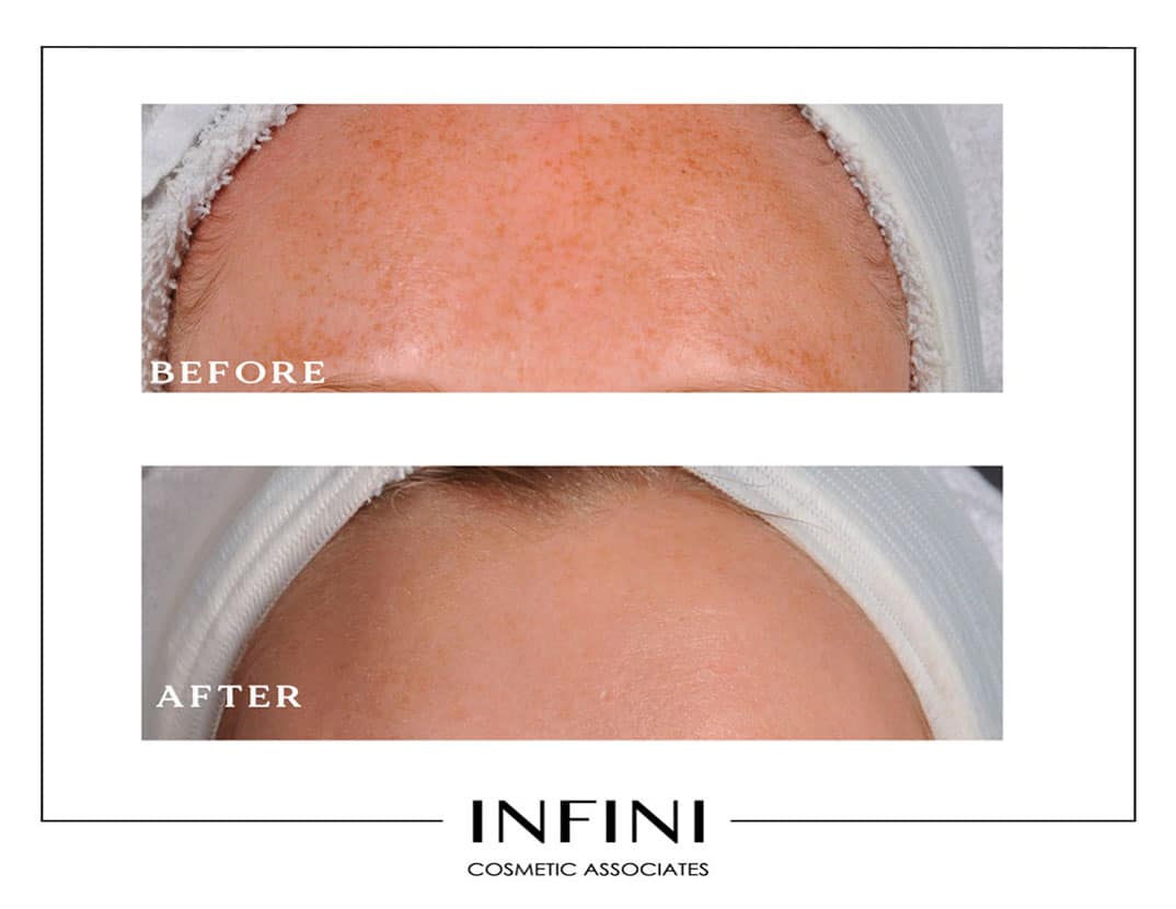 Photofacial before and after results - Patient 5