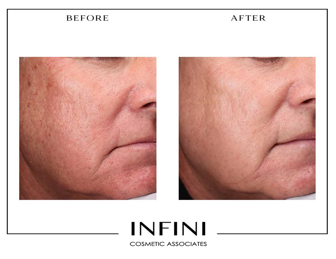Photofacial before and after results - Patient 1