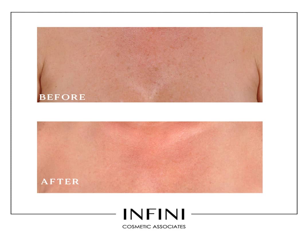 Photofacial before and after results - Patient 3