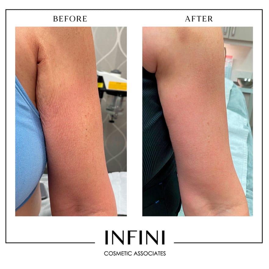 Photofacial before and after results - Patient 4