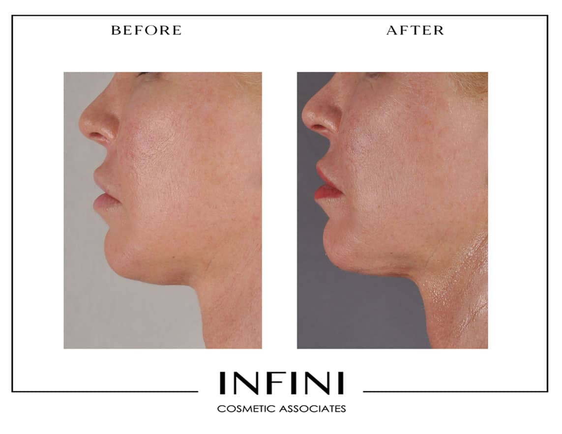 Photofacial before and after results - Patient 3