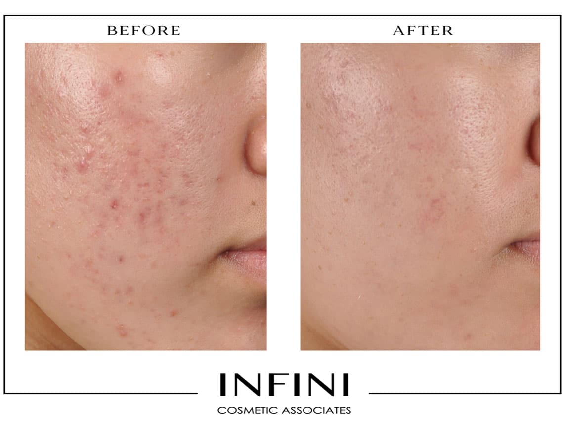 Photofacial before and after results - Patient 2