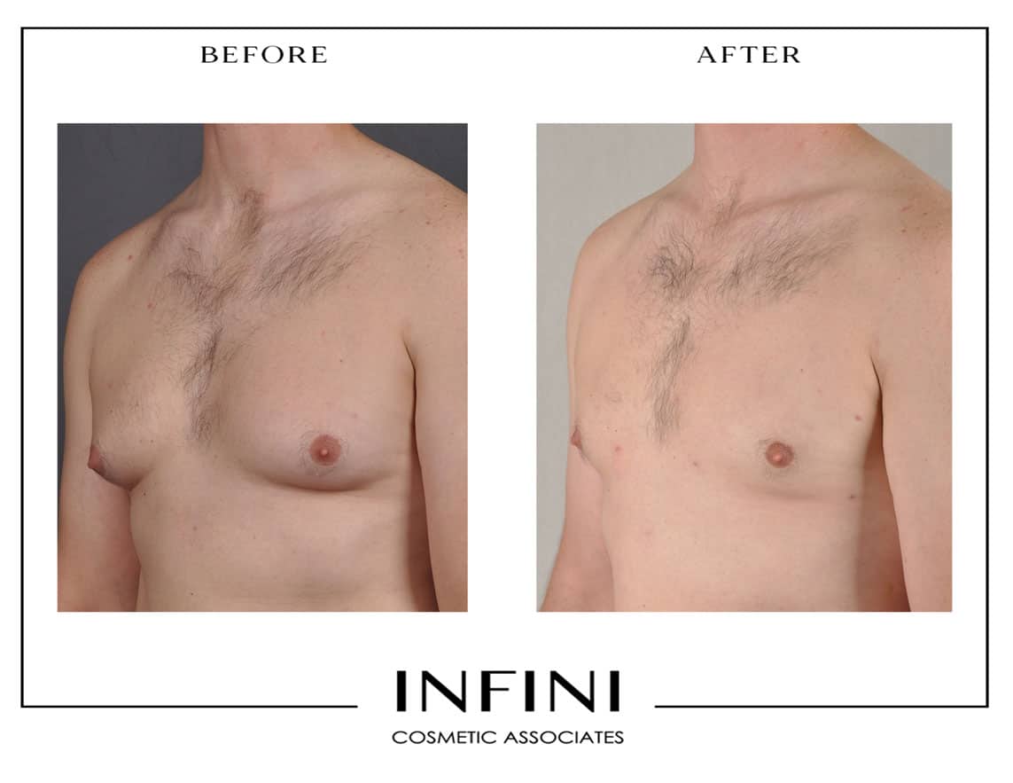Gynecomastia  before and after results - Patient 3