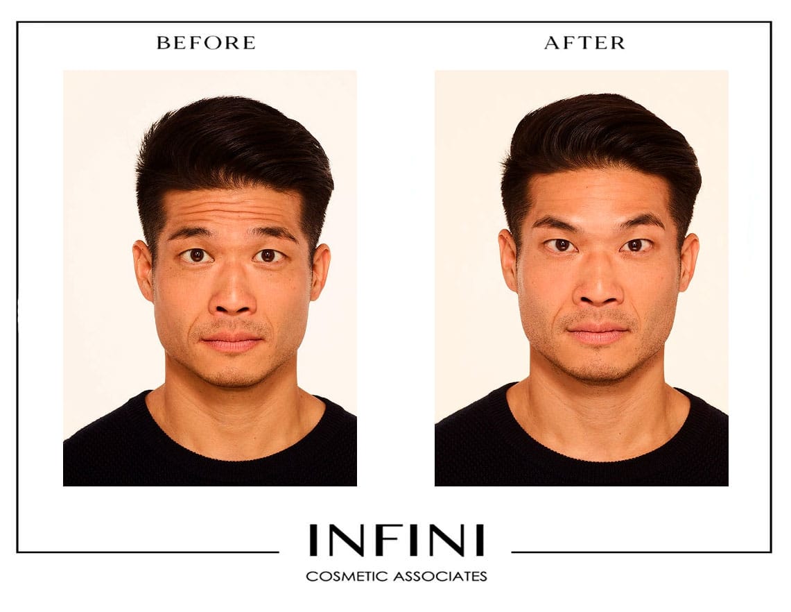 Botox before and after results - Patient 3