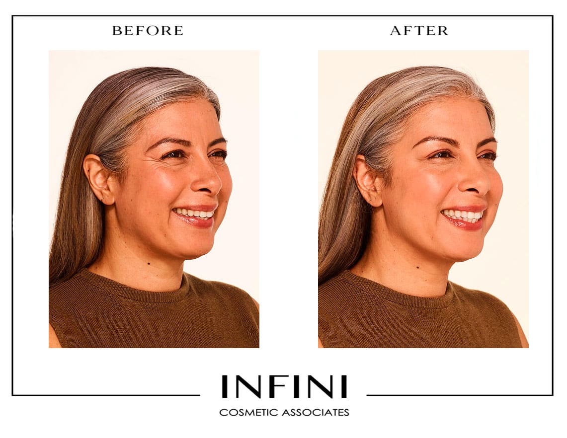 Botox before and after results - Patient 4