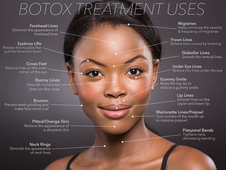 Botox treatment areas