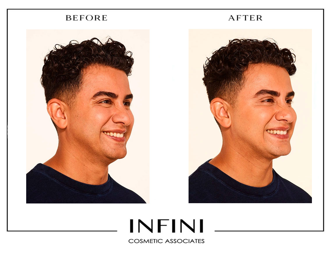 Botox before and after results - Patient 1