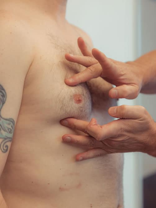 Understanding Gynecomastia: More Than Just Weight