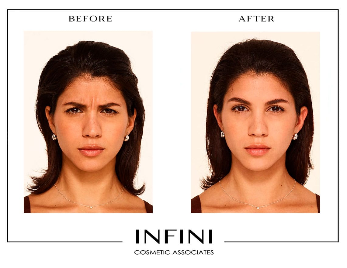 Botox before and after results - Patient 2