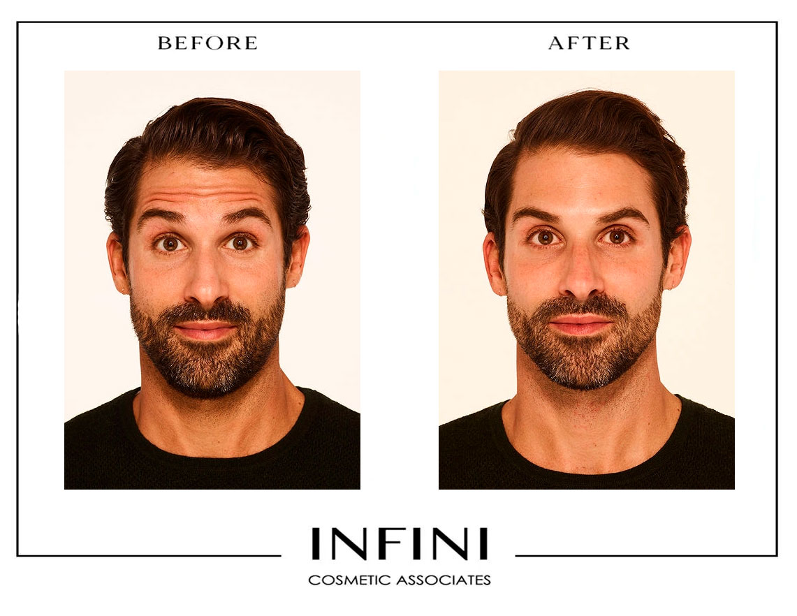 Botox before and after results - Patient 5