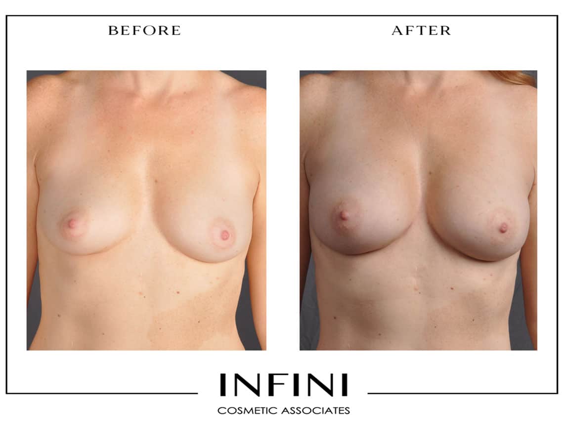 Fat Transfer to Breast - Patient 4