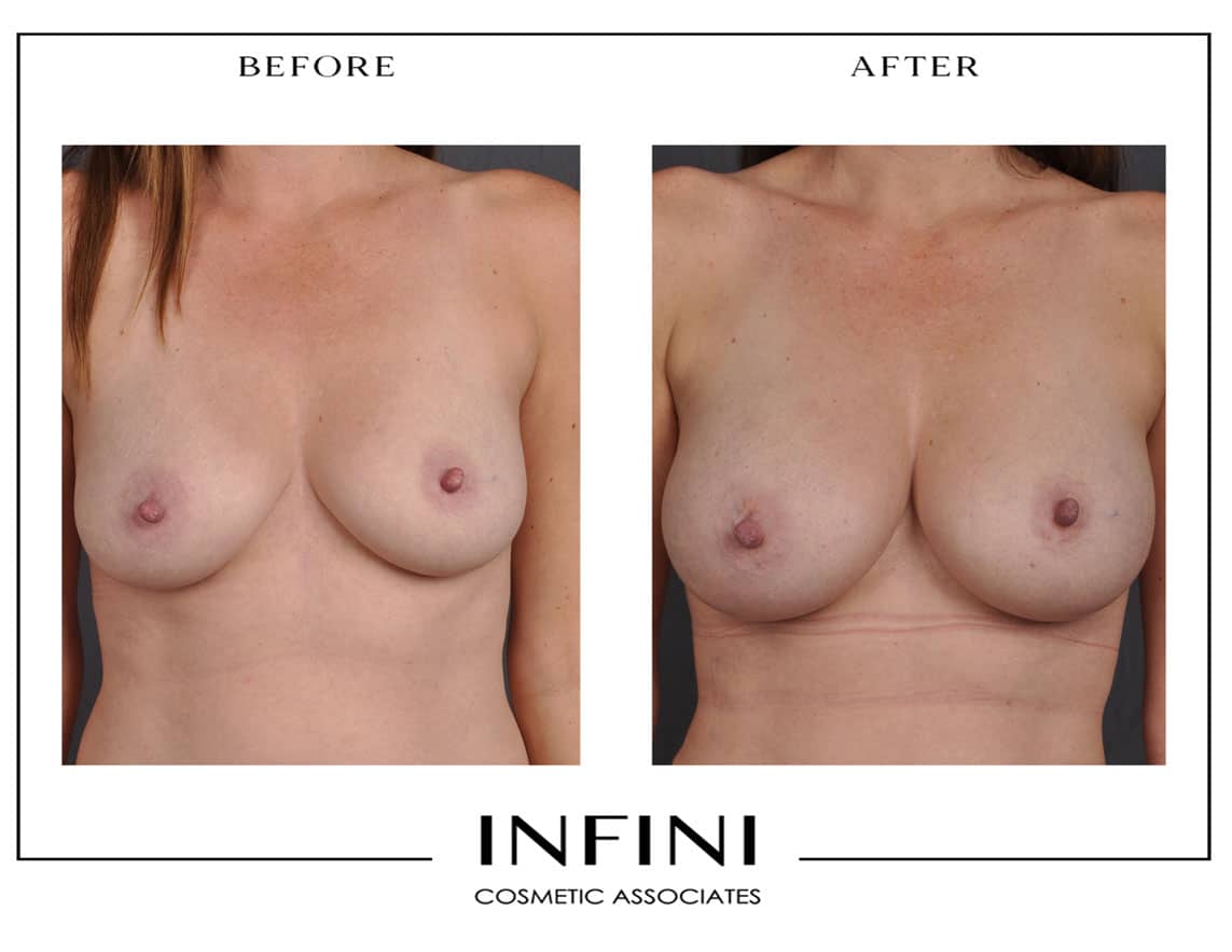 Fat Transfer to Breast - Patient 3