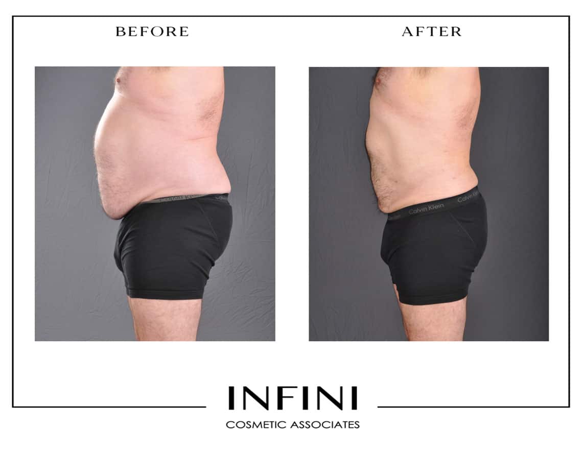 Male Liposuction - Patient 4