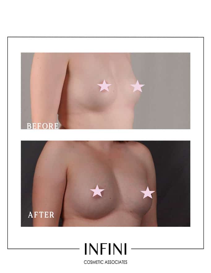 Fat Transfer to Breast - Patient 2