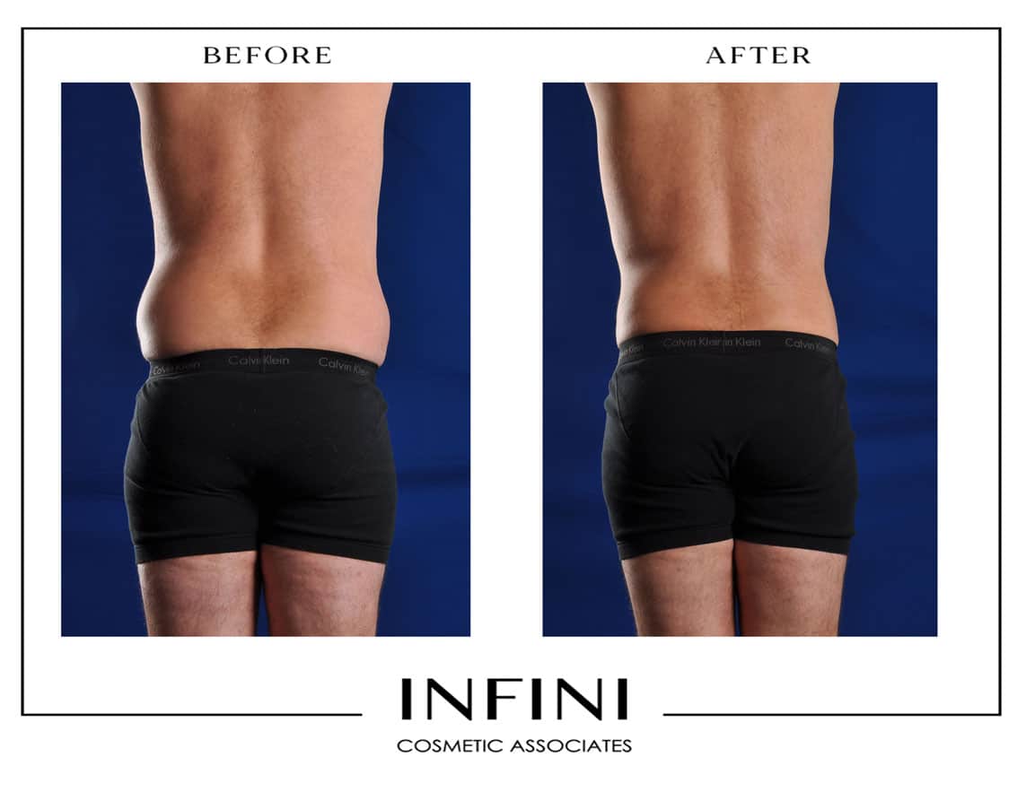 Male Liposuction - Patient 3