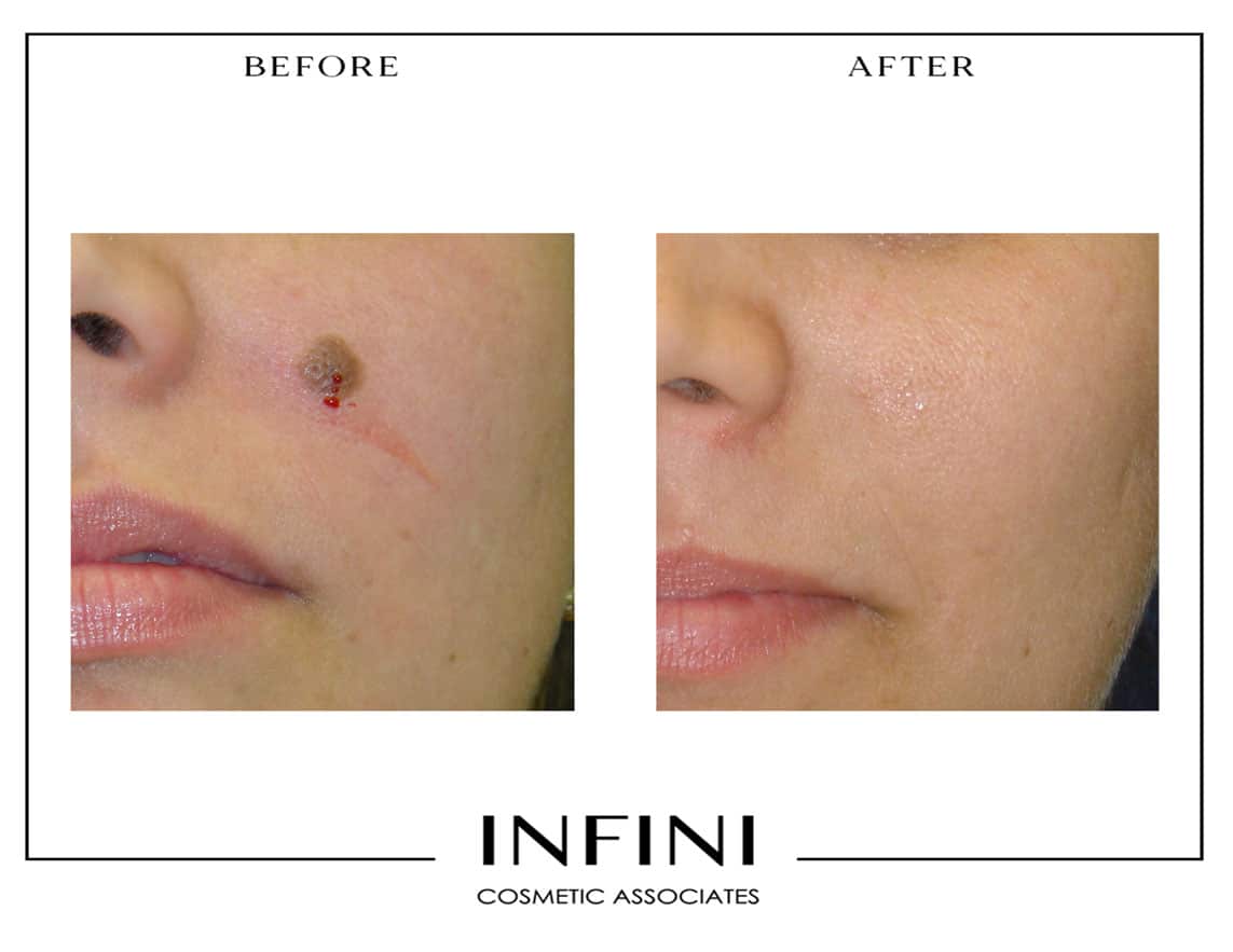 Mole Removal - Patient 1