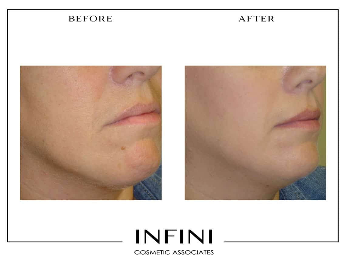 Mole Removal - Patient 2