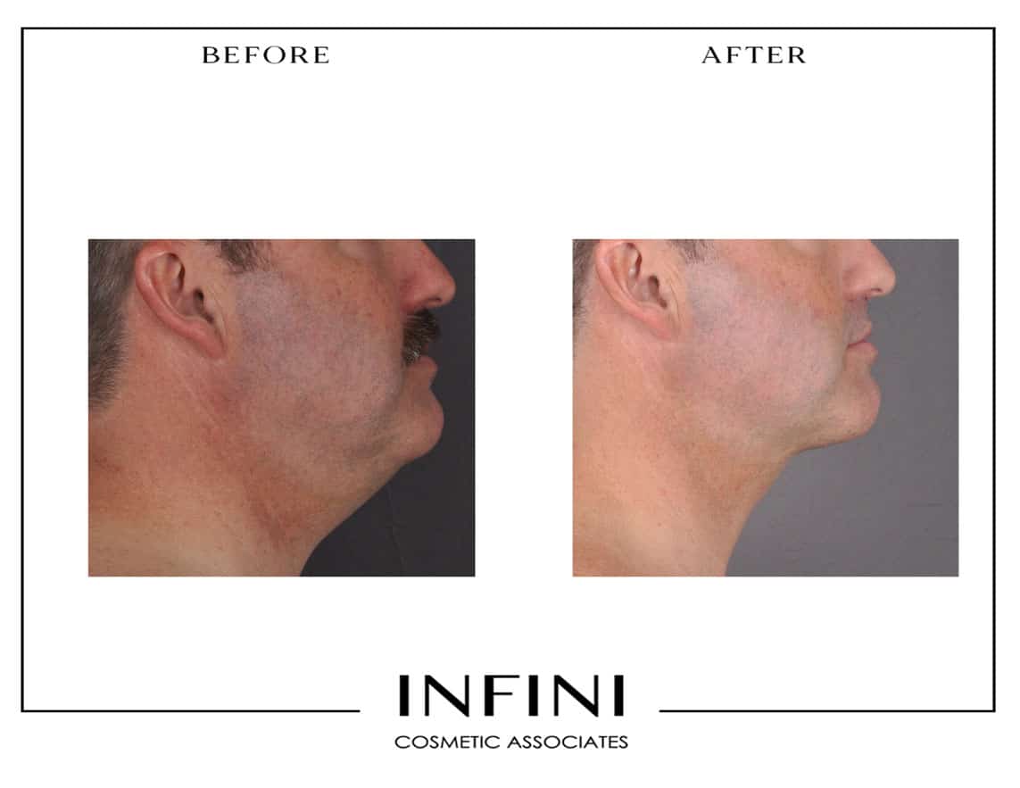 Male Liposuction - Patient 1