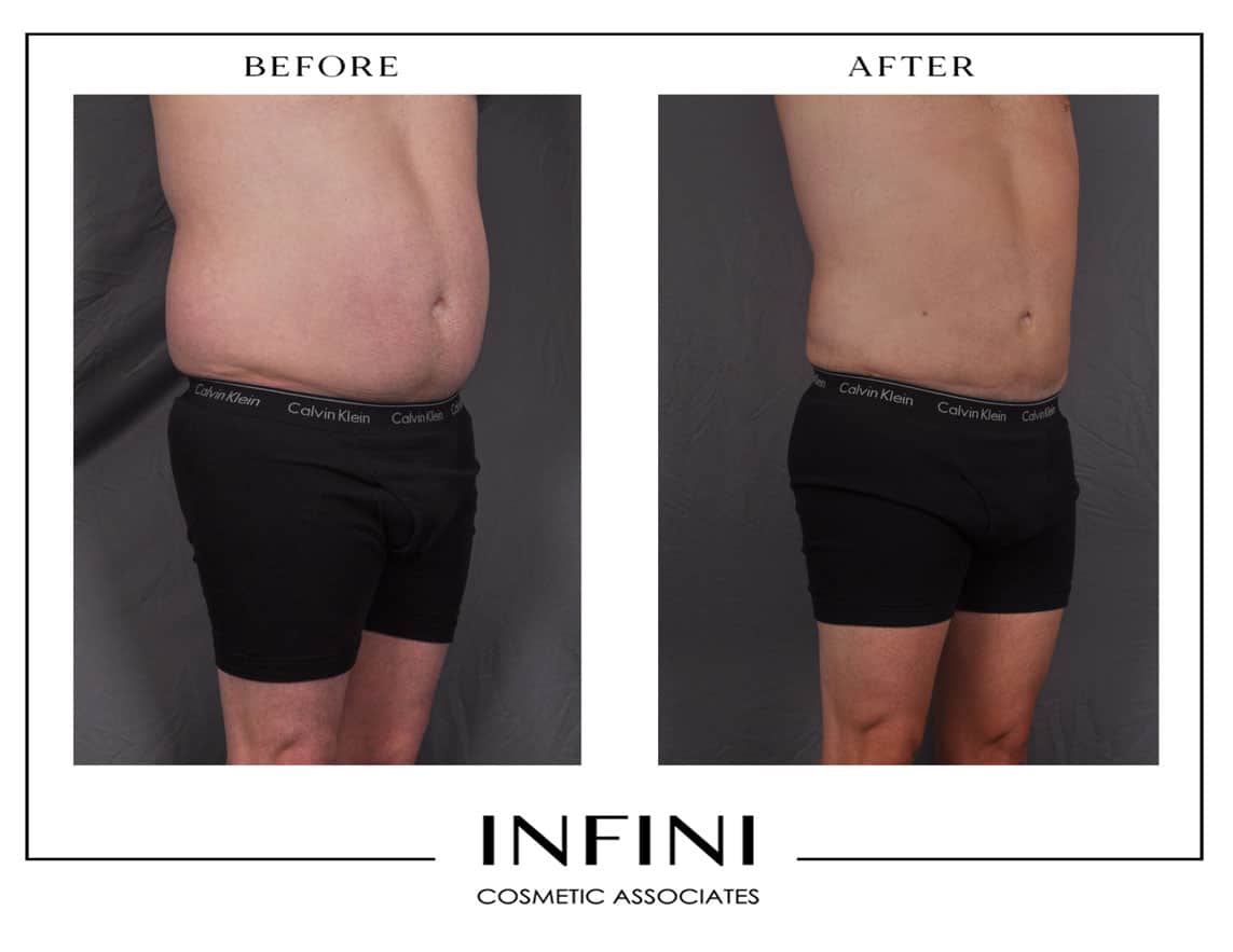 Male Liposuction - Patient 4