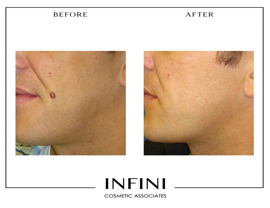 Mole Removal - Patient 3