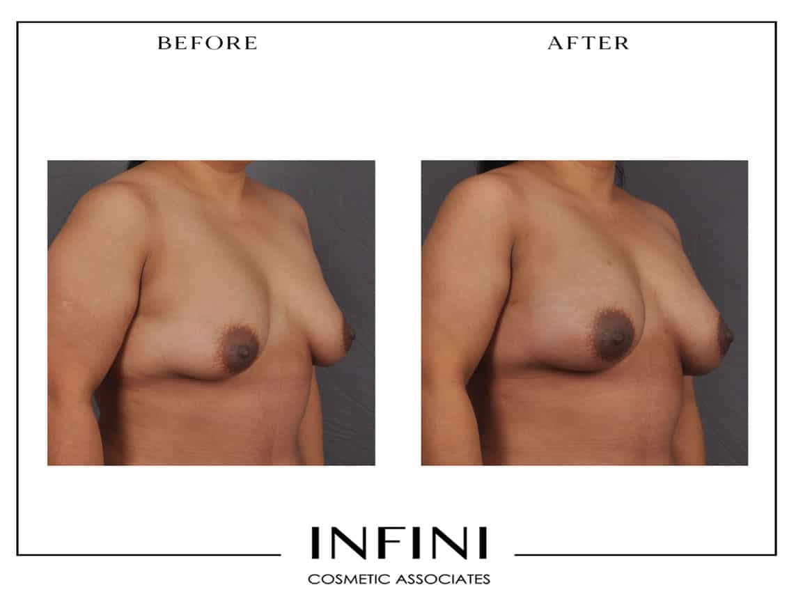 Fat Transfer to Breast - Patient 1